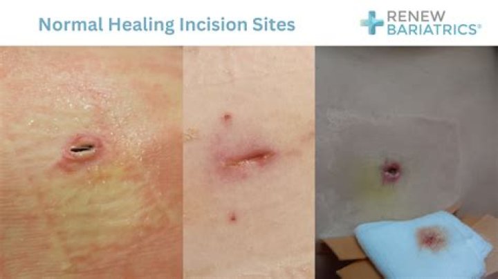 Can a healed scar get infected?