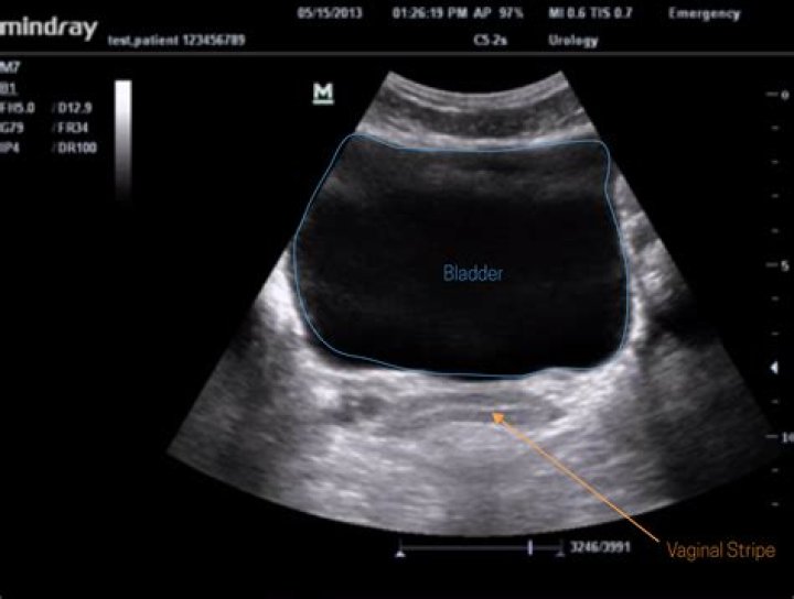 What can an ultrasound on bladder show?